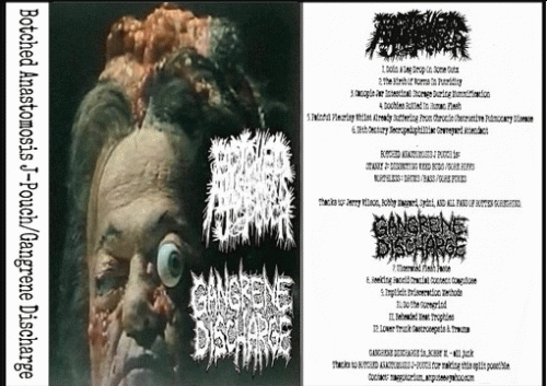 Gangrene Discharge : Botched Anastomosis J-Pouch - Gangrene Discharge
